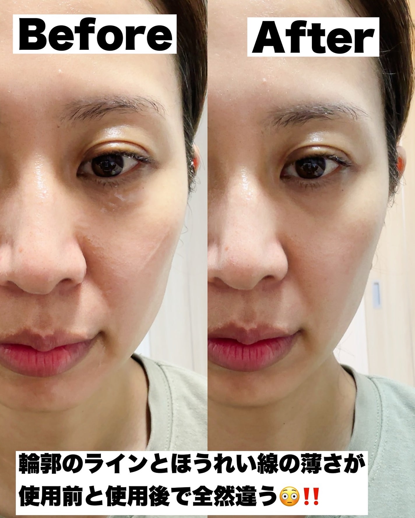 RF温冷美顔器PRO/ANLAN/美顔器・マッサージを使ったクチコミ(2枚目)