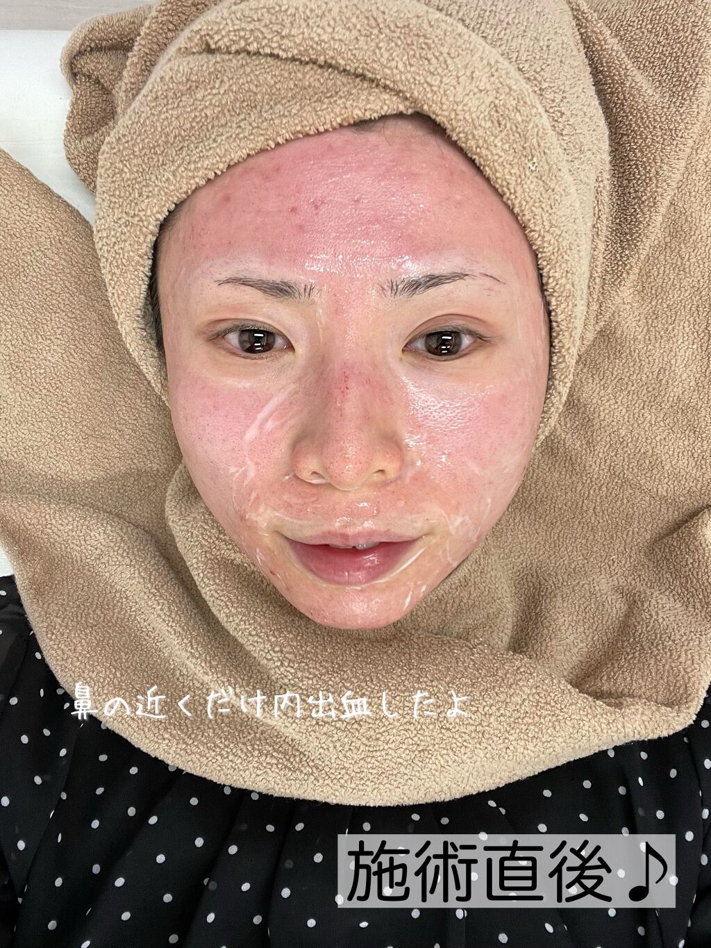 あゆみんっ。 on LIPS 「最近何かと話題な美容医療施術【ダーマペン4】当日終わってまで編..」(2枚目)