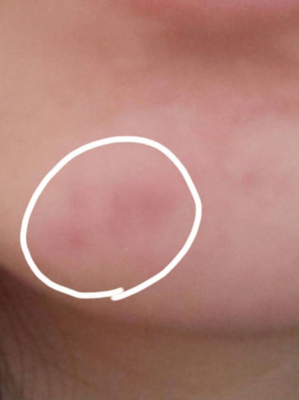 プロCICA クリアスポットパッチ/VT/その他スキンケアを使ったクチコミ(4枚目)