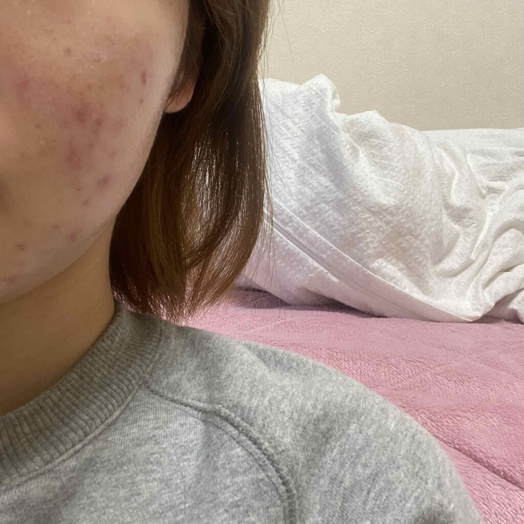 ゆうか on LIPS 「お肌日記11.10..」(2枚目)