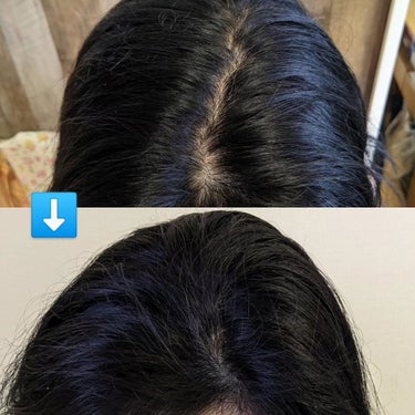 継続レポ📝育毛剤&育毛レーザーを使用して4か月後
始めた頃との写真を比較して驚きました👀‼️

3か月後に
黒々～🌈フサフサー
髪の毛がペタリとしていたのが
今はフサフサ立ち上がっています⤴️
地肌が見