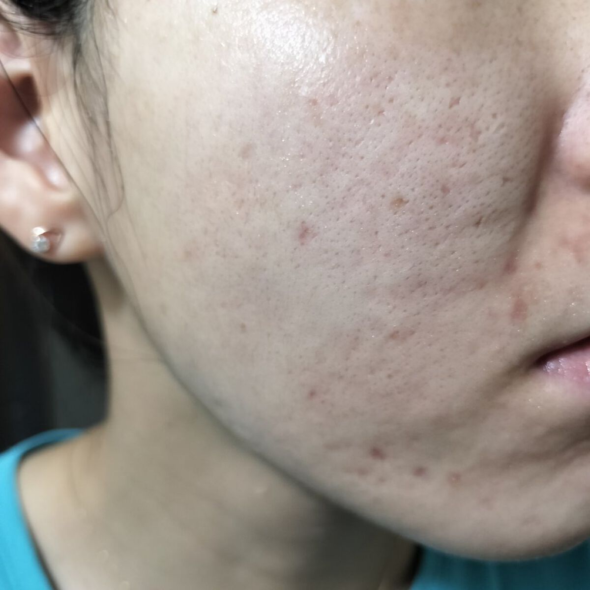 Azelaic Acid Suspension 10%/The Ordinary/美容液を使ったクチコミ（1枚目）