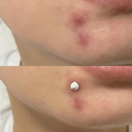 ミラクルアクネクリアスポットトリートメント/SOME BY MI/美容液を使ったクチコミ(3枚目)