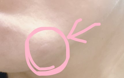 ビューティー スポットパッチ/イージーダムビューティー/にきびパッチを使ったクチコミ(6枚目)