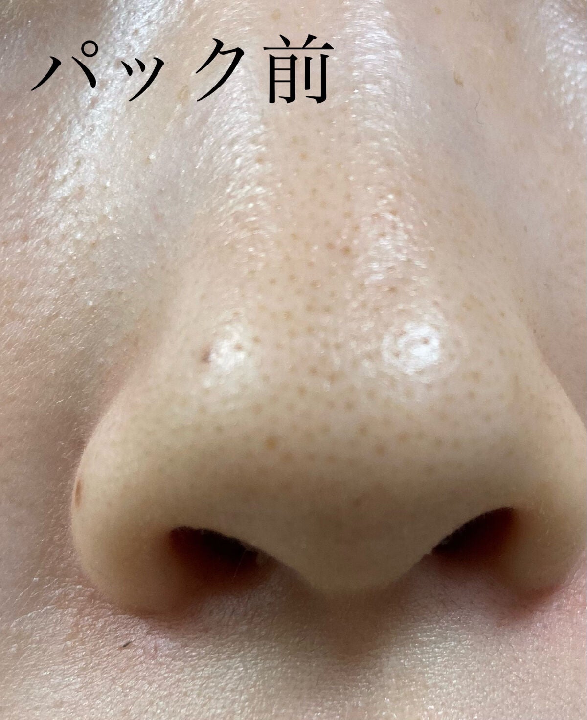 毛穴小町 ブラックピールオフパック/クリアターン/ピーリングを使ったクチコミ(5枚目)