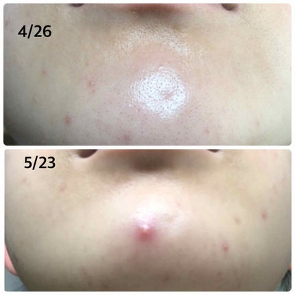 皮脂トラブルケア 保湿ジェル/キュレル/化粧水を使ったクチコミ(4枚目)