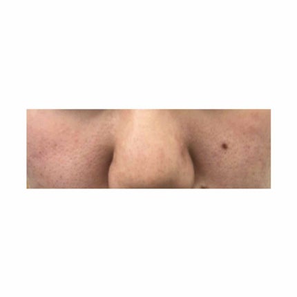 ゆうり on LIPS 「小学生の時からニキビに悩んではや6年目??(現在高2です)半年..」(4枚目)