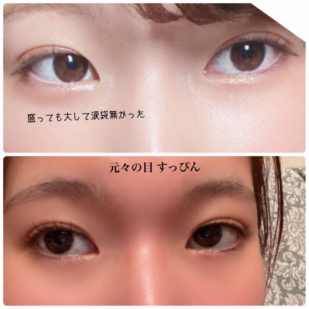 Yちゃん on LIPS 「【昨日涙袋ヒアルロン酸入れました!!!🎉🎉🎉】初めて、プチ整形..」(2枚目)