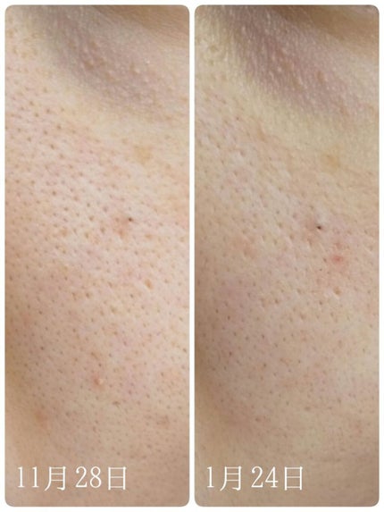 N10+Z1フェイスセラム /The Ordinary/美容液を使ったクチコミ(4枚目)