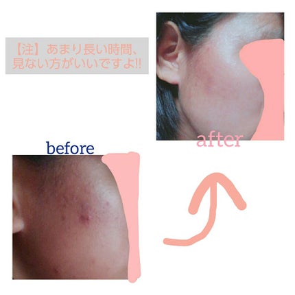 ハトムギ美容水 in ヒアルロン酸/パエンナ/化粧水を使ったクチコミ(2枚目)