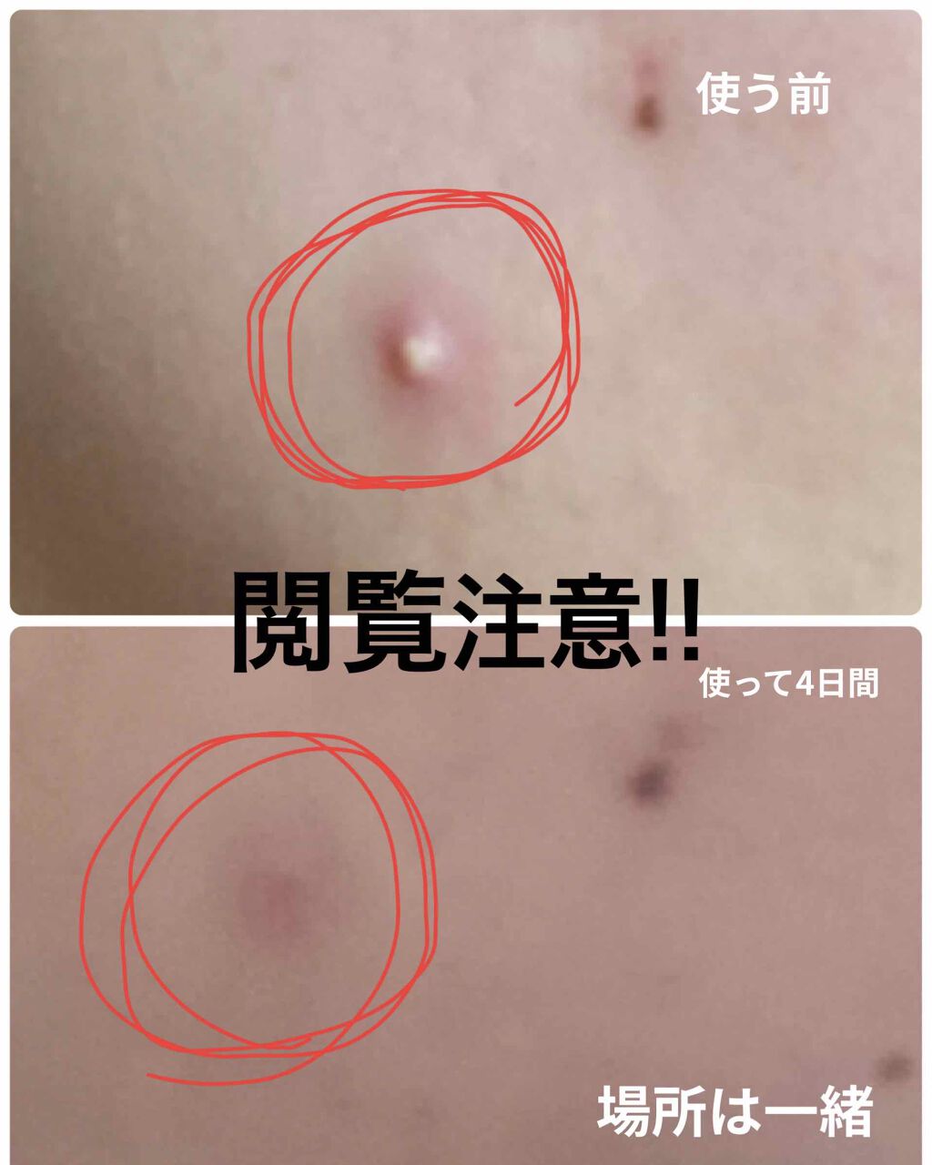 ゼロスポットパッチ/Today’s Cosme/にきびパッチを使ったクチコミ(1枚目)