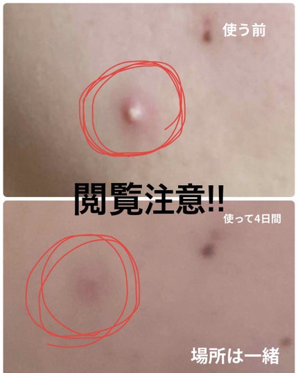 ゼロスポットパッチ/Today’s Cosme/にきびパッチを使ったクチコミ(1枚目)