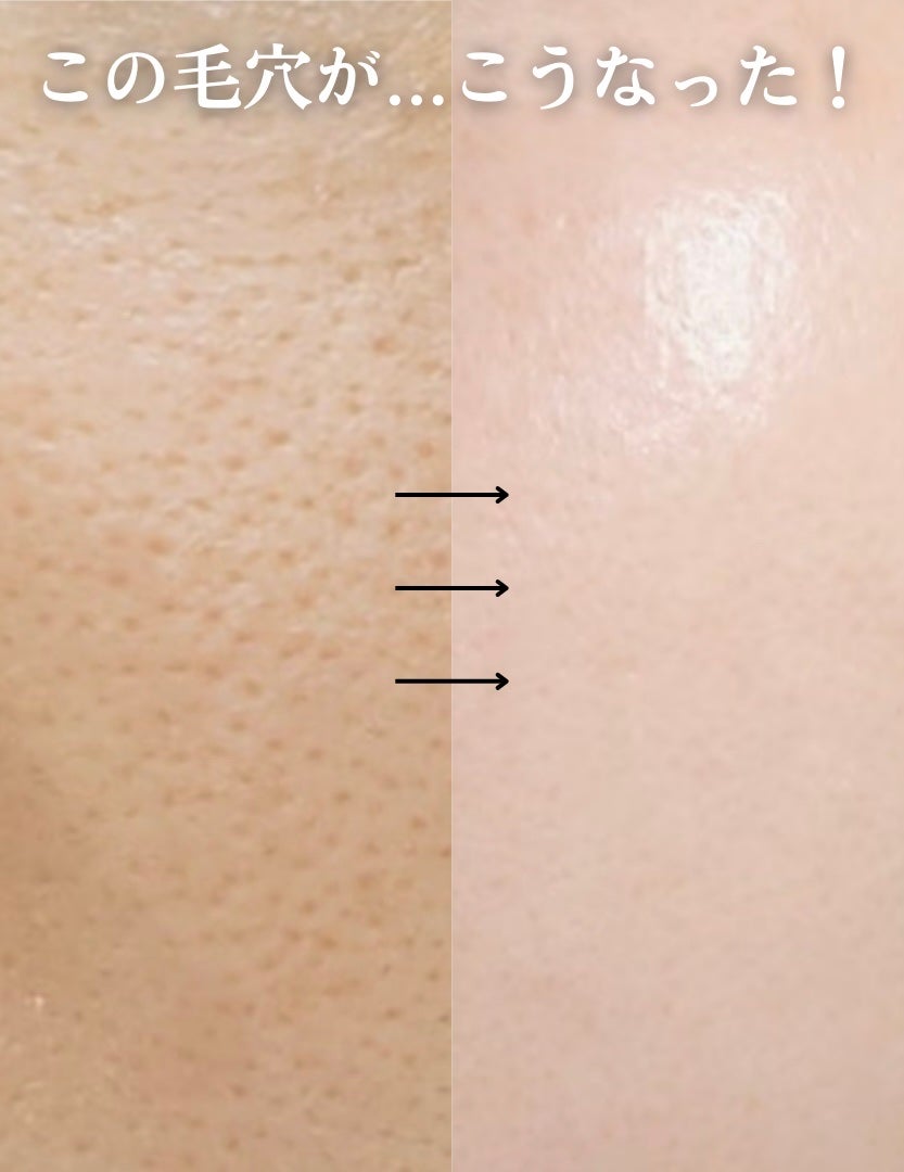 pomu on LIPS 「初売りセールの今がお買い得💖最速で全肌悩み消す方法開き毛穴、赤..」(1枚目)