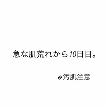 急な肌荒れから10日経ちました。

おでこは落ち着いた気がするけど
やっぱり鼻周りがざらつく…
というかでかいニキビが出来ました。

洗顔はスキンライフ。

一昨日メディヒールの
ティーツリーパックが来