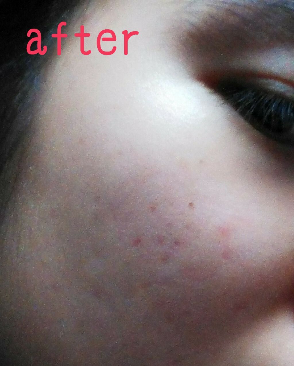 A アクネローション/NOV/化粧水を使ったクチコミ（3枚目）