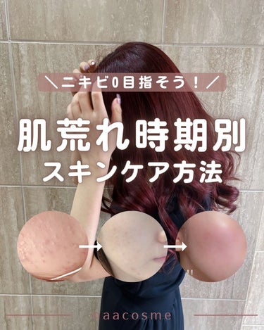 私は肌荒れ治すまでに皮膚科・スキンケア・コスメ・美容施術…
100万円以上使ったけど、ほとんどが失敗でした😱

肌荒れ地獄期→ニキビ跡期→いま
の3つに分けて、それぞれの時期別に試したスキンケアをまとめ