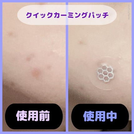 ビューティー スポットパッチ/イージーダムビューティー/にきびパッチを使ったクチコミ(4枚目)