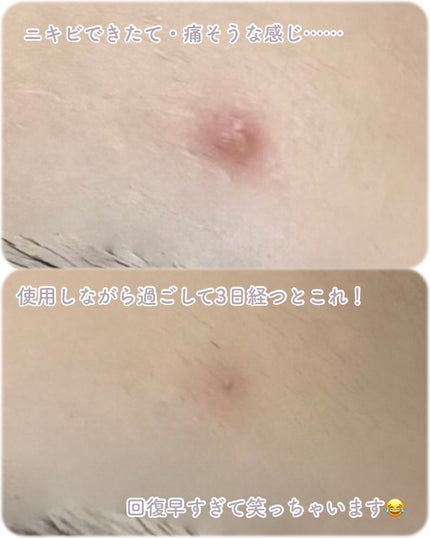 SPOT PATCH ロールタイプ/Shupong/にきびパッチを使ったクチコミ(5枚目)