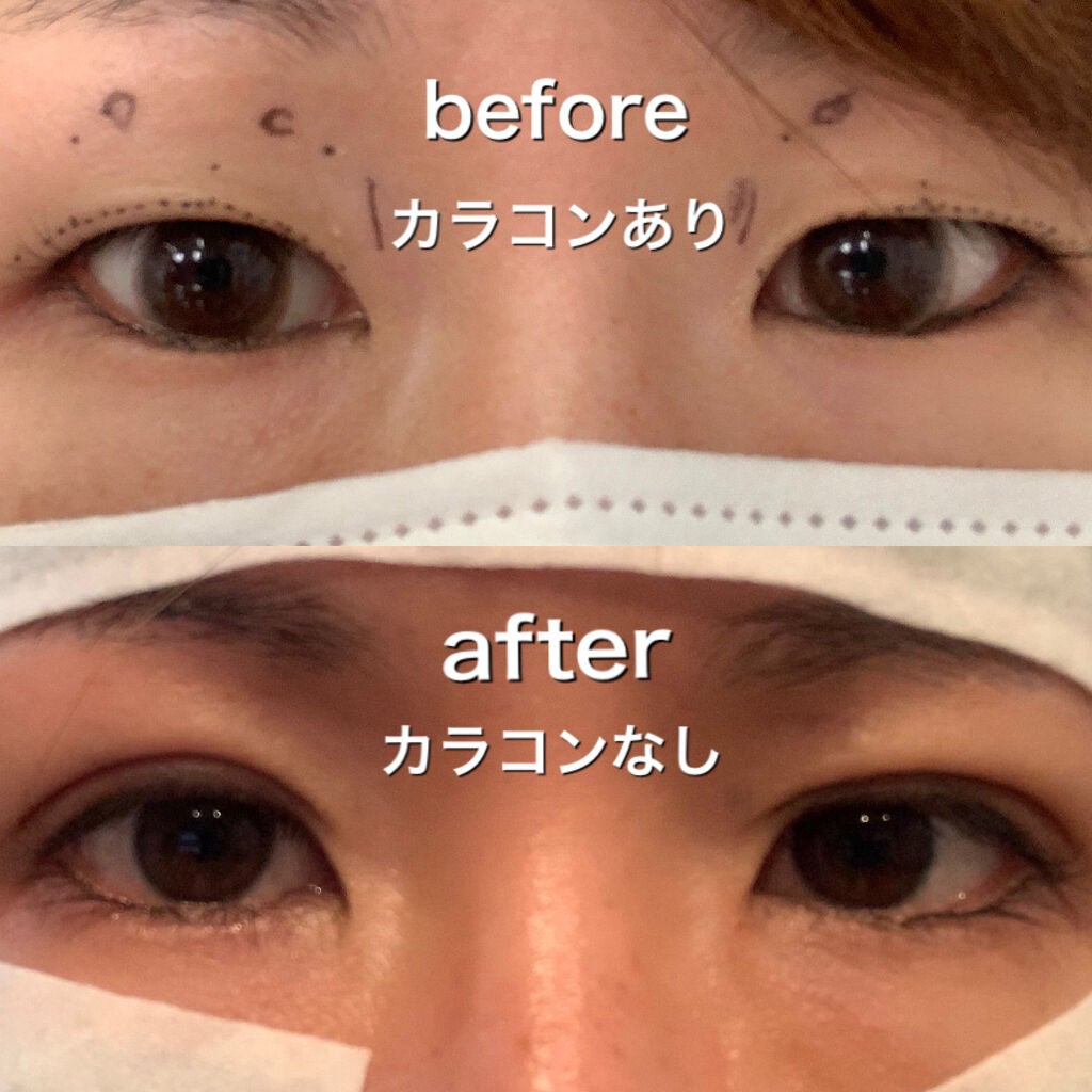 yu___n@フォロバします🌸 on LIPS 「二重埋没して3週間経ちました!1週間までのレポは別投稿にあるの..」(2枚目)