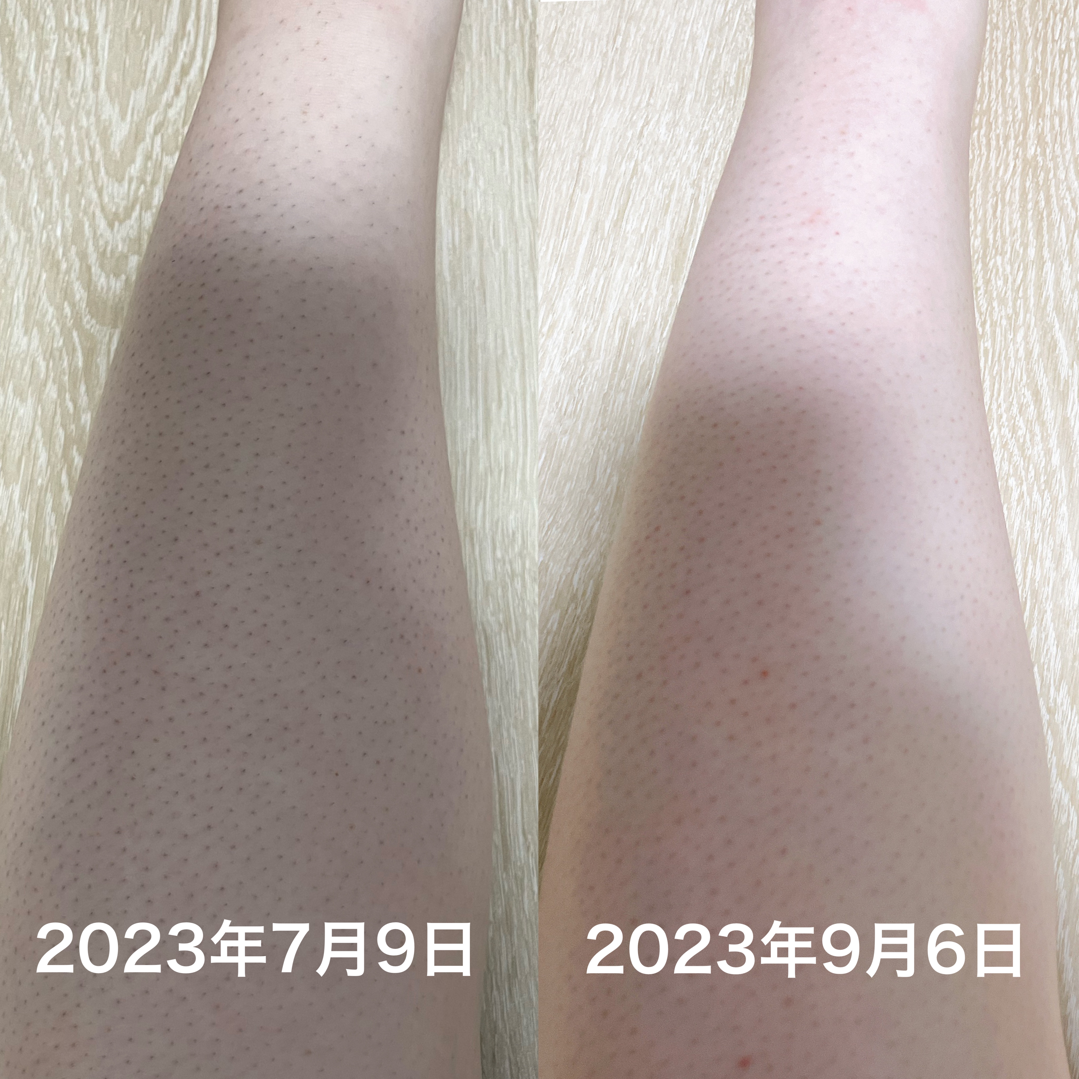 脱毛器 冷感 家庭用/Sarlisi/家庭用脱毛器を使ったクチコミ（3枚目）