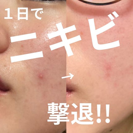 ハイドロコロイドスキンパッチ/ビューティーワールド/その他を使ったクチコミ(1枚目)