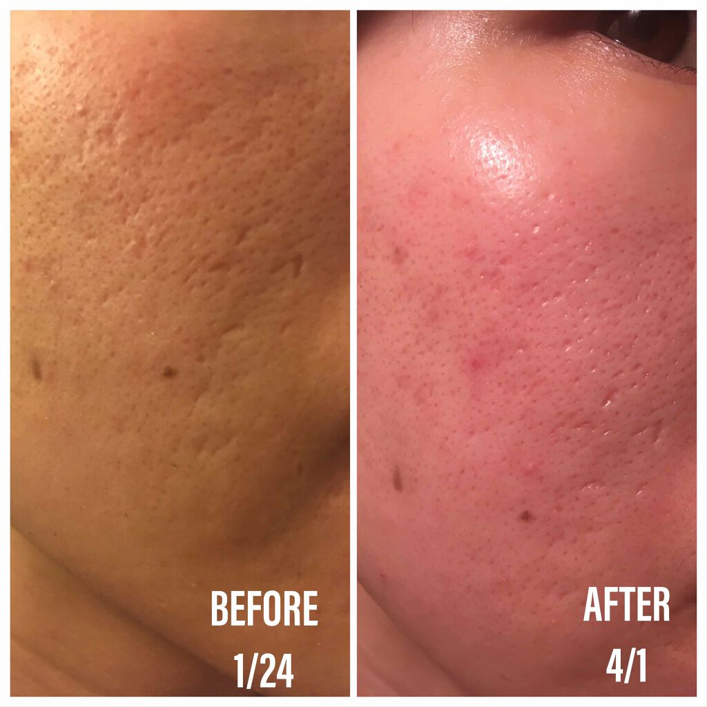 DS ライン コンセントレート 12.5 C/Kiehl's/美容液を使ったクチコミ(3枚目)