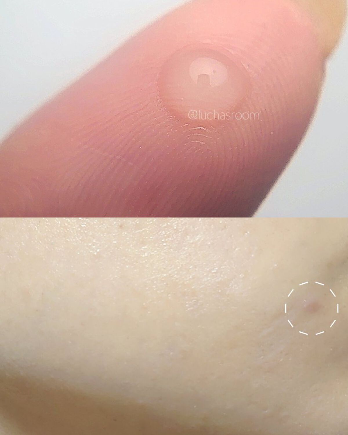 大人のニキビ対策 薬用クリアスポッツ美容液 /肌美精/美容液を使ったクチコミ（2枚目）