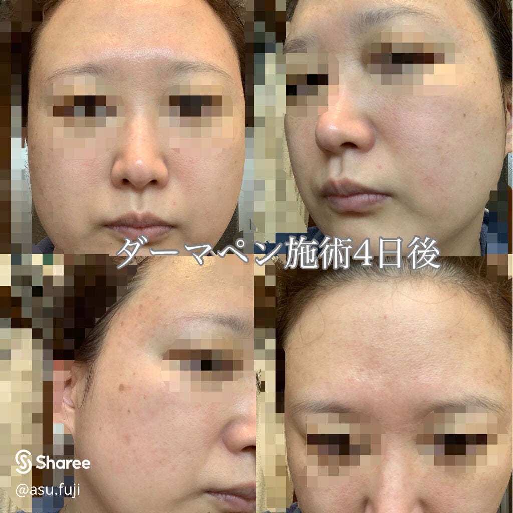 asu.fuji on LIPS 「ダーマペンのダウンタイムの続きです。前回の投稿は、2日目までし..」(3枚目)