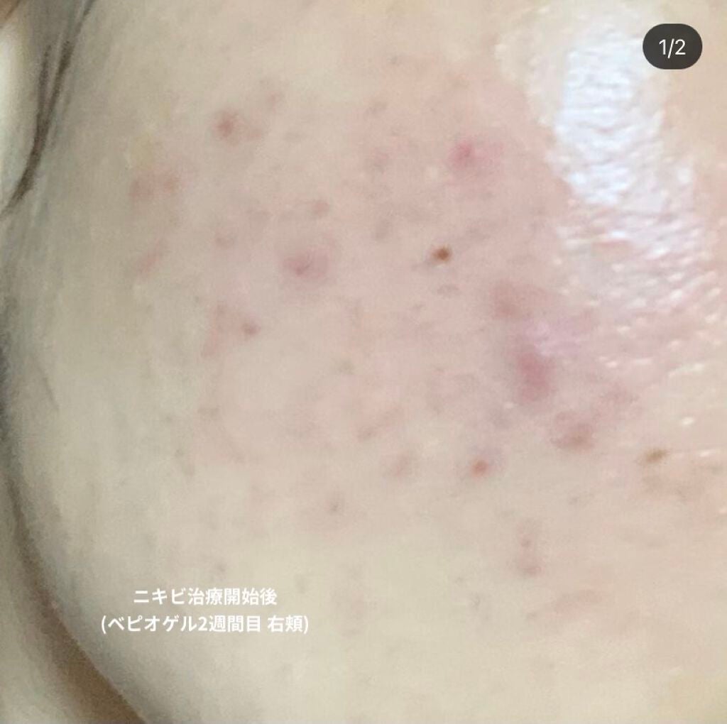 K on LIPS 「12/23~2/1までの経過12/23~1/10べピオゲル1/..」(2枚目)