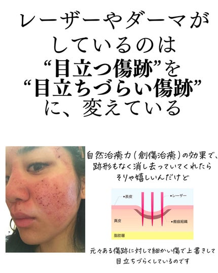 おゆみ|ニキビ・ニキビ跡ケア on LIPS 「@______ohyoume◀︎他の投稿はこちらから💄【レーザ..」(3枚目)