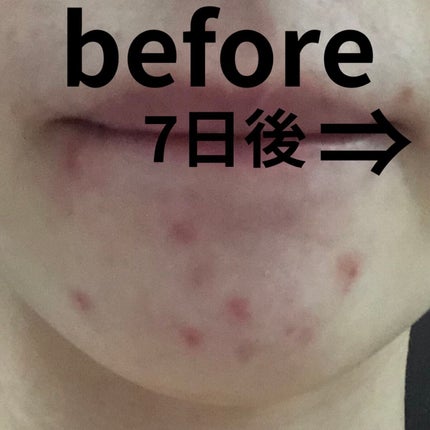 ドクダミ 77 スージングトナー/Anua/化粧水を使ったクチコミ(1枚目)