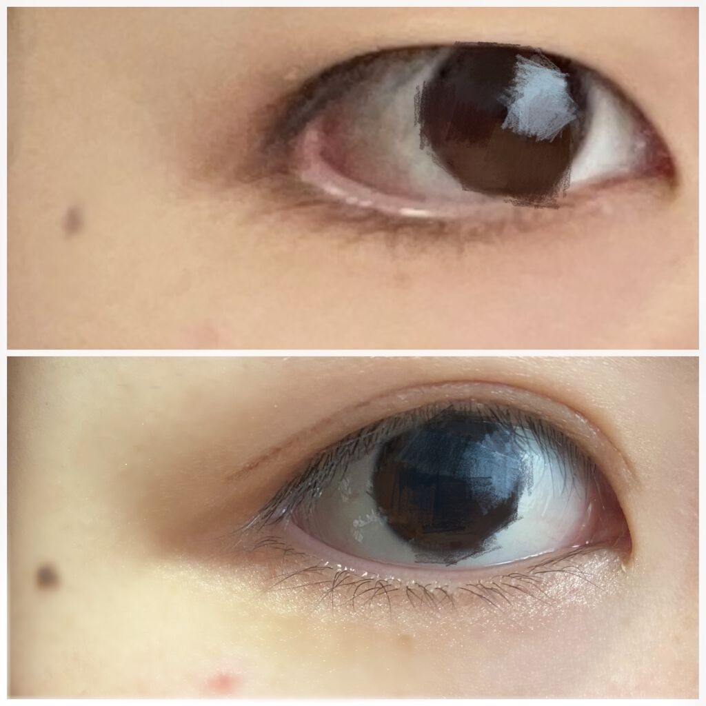 アクティブアイトークII/アイトーク/二重まぶた用アイテムを使ったクチコミ（1枚目）