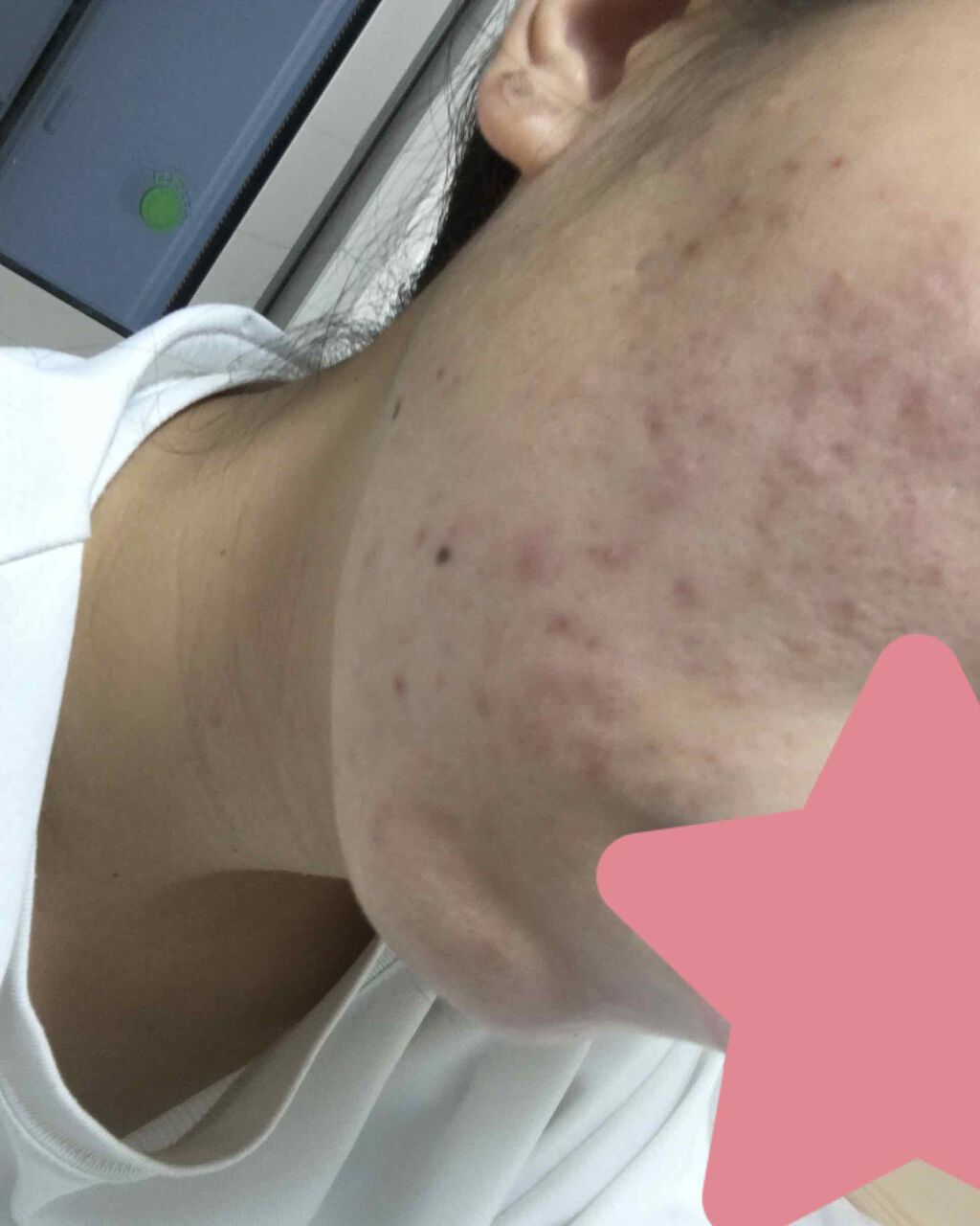 ベピオゲル/マルホ株式会社/その他を使ったクチコミ（1枚目）