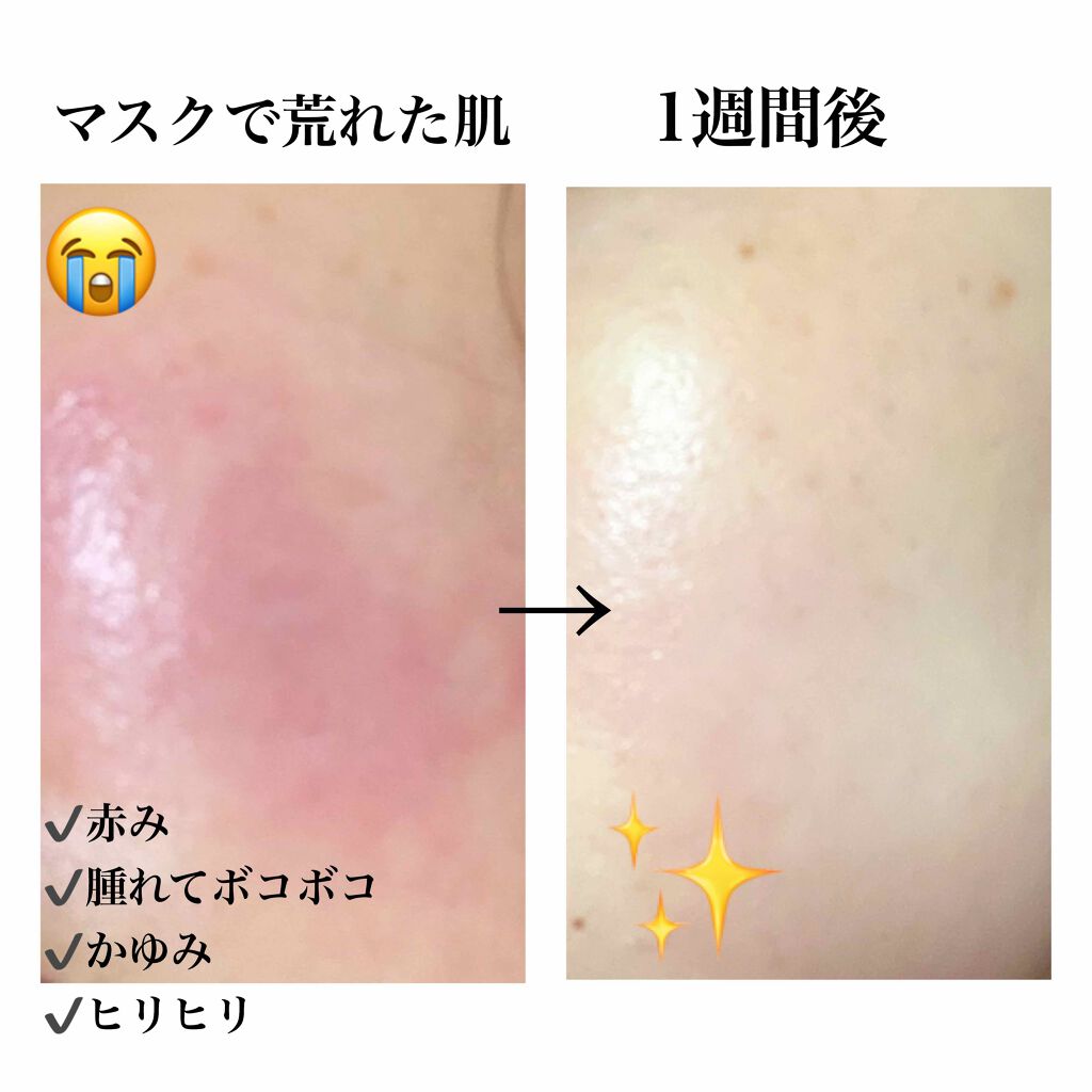 プリスクリードaa 医薬品 Ihadaの使い方を徹底解説 マスクで肌湿疹が起こりました 実際に改善さ By ハル 乾燥肌 代前半 Lips プリスクリードaa 医薬品 Ihadaの使い方を徹底解説 マスクで肌湿疹が起こりました 実際に改善さ By ハル 乾燥肌 代前半 Lips