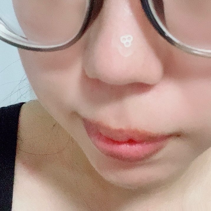 ACマグネシウムパッチ ミニ/スノーツープラス/にきびパッチを使ったクチコミ(4枚目)