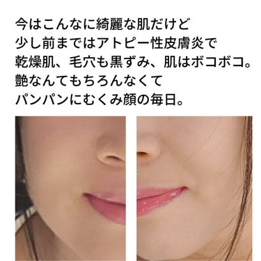 美肌カウンセラー💆綺麗のお助け相談所 on LIPS 「【肌が綺麗だとドンドン得をする🧙‍♀️】元々は重度のアトピー性..」（2枚目）