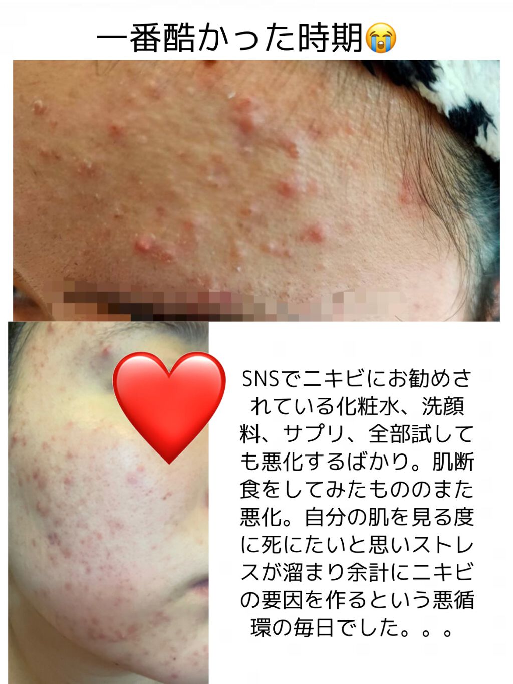 A アクネフォーム/NOV/洗顔フォームを使ったクチコミ(5枚目)