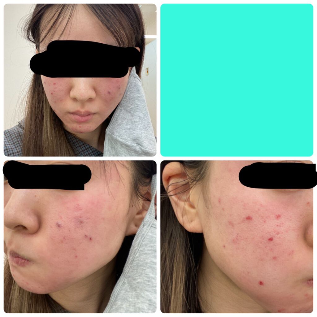 試してみた】AHAマイルドソープ イデアルポーの効果・肌質別の口コミ