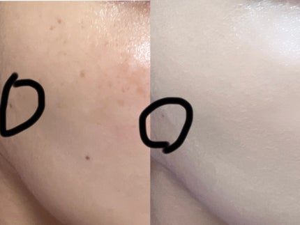 ひなまる on LIPS 「いきなり汚い肌を見せてしまい申し訳ございません🙇♀️同じよう..」(3枚目)