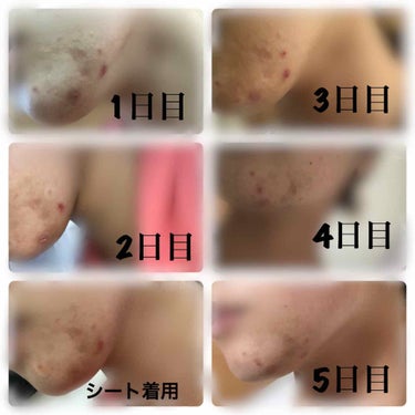 のんた on LIPS 「はじめまして！のんたです！ニキビ、出始めニキビ、ニキビ跡に効く..」（3枚目）