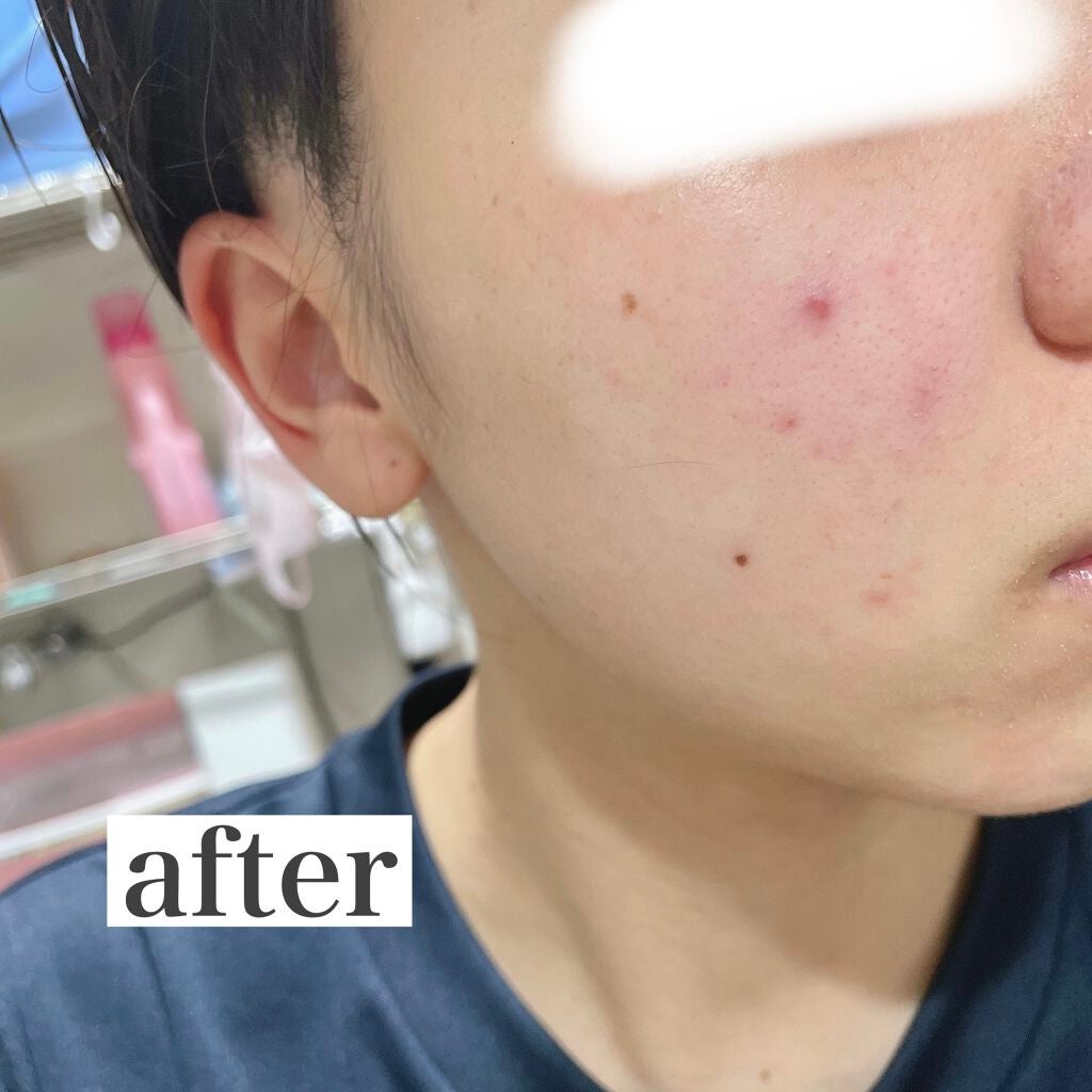 高濃度炭酸パック/17skin/シートマスク・パックを使ったクチコミ(5枚目)