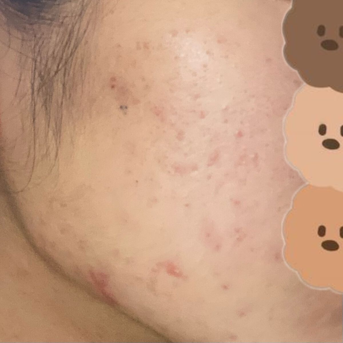 シカレチA クリーム0.05/VT/フェイスクリームを使ったクチコミ（3枚目）