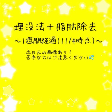 埋没法＋脂肪除去してから昨日で1週間経ちました。

埋没法も脂肪除去も通常腫れは2、3日〜1週間ほどで引くみたいなのですが、私の場合は初日よりはだいぶ引きましたがまだ完全には引いていません…

もしかし