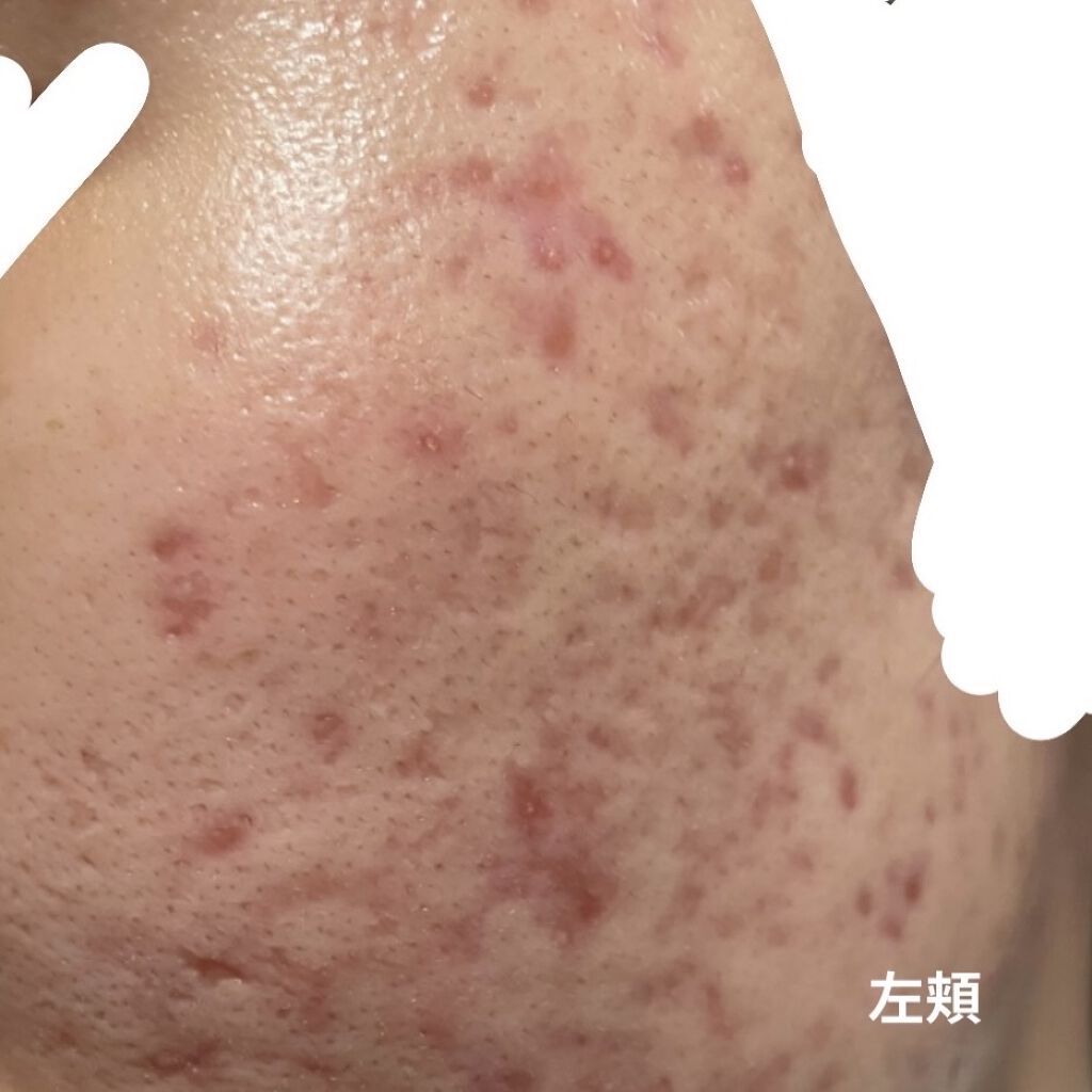 モイスチャー 1セット/エンビロン/トライアルキットを使ったクチコミ（3枚目）