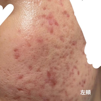 シカゴ― シカSOSマスク/ISOI/シートマスク・パックを使ったクチコミ(3枚目)