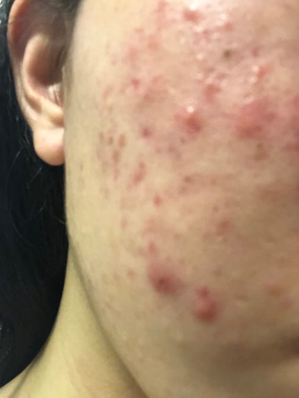 スキンケア洗顔料 薬用アクネケア/ビオレ/洗顔フォームを使ったクチコミ(2枚目)