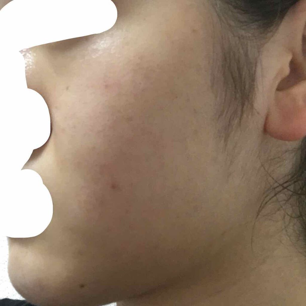 ハイチオールBクリア/エスエス製薬/美容サプリメントを使ったクチコミ（3枚目）