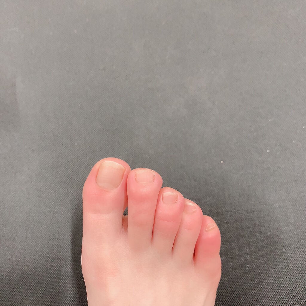 オロナインH軟膏 (医薬品)/オロナイン/その他を使ったクチコミ(2枚目)