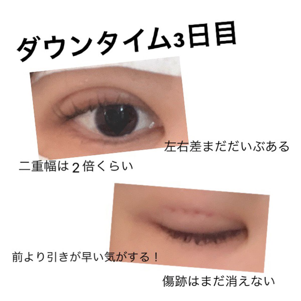 二重整形/その他を使ったクチコミ（1枚目）