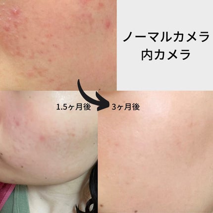 つり目ちゃん on LIPS 「汚肌からお肌に!やっと普通の肌に近づけてきました!やっぱり、ニ..」(1枚目)